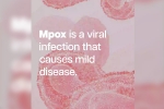 Mpox, mpox cases, mpox emergency again, Back pain