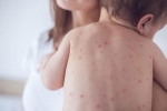 measles treatment, measles vaccine, measles back in the united states as children omit vaccination doses, Toddler