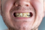 Nicotine stains irreversible, Nicotine stains teeth, are nicotine stains on your teeth irreversible, Strips