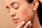 skin, home remedies, 10 ways to get rid of pimples at home, Unsc