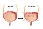 Overactive Bladder latest, Overactive Bladder signs, here are some warning signs of an overactive bladder, Obesity